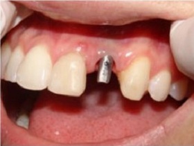 Dental Implants