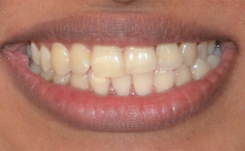 Whitening or Toth Bleaching