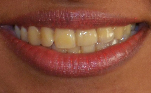 Whitening or Toth Bleaching