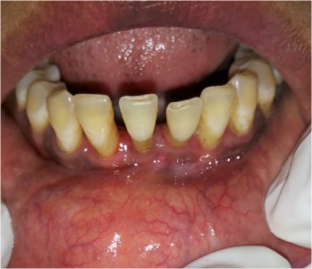 Bleeding Gums