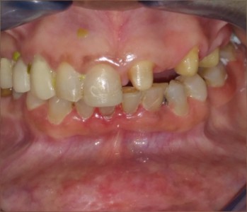 Dental Bridge