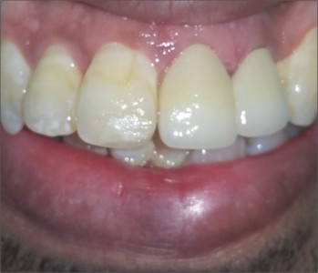 Dental Crowns