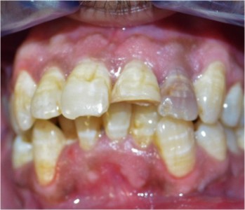 Dental Crowns