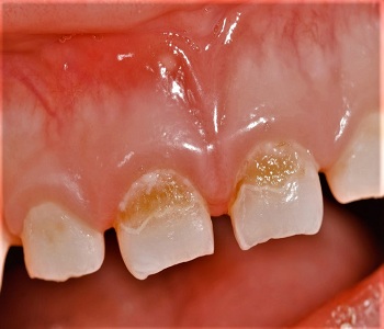 Case showing cavity due to feeder bottle
