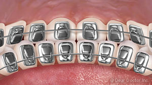 Lingual Braces