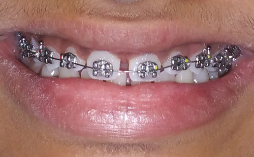 Traditional Metal Braces