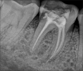 Root Canal