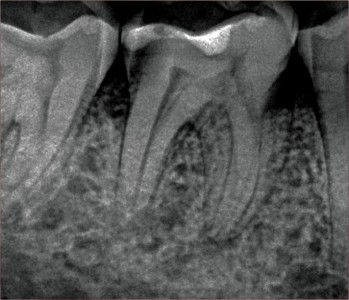 Root Canal