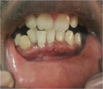 Swollen Gum