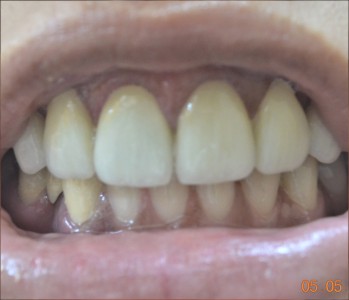 Veneers