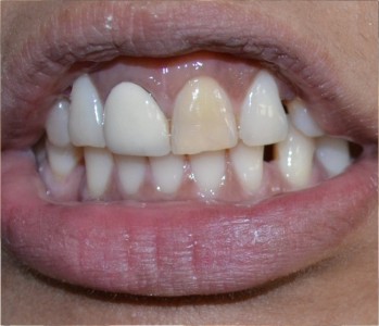 Veneers