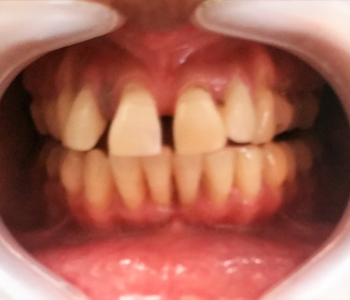 Veneers