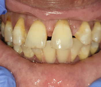 Partial Dentures