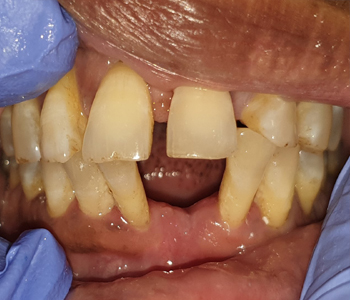 Partial Dentures